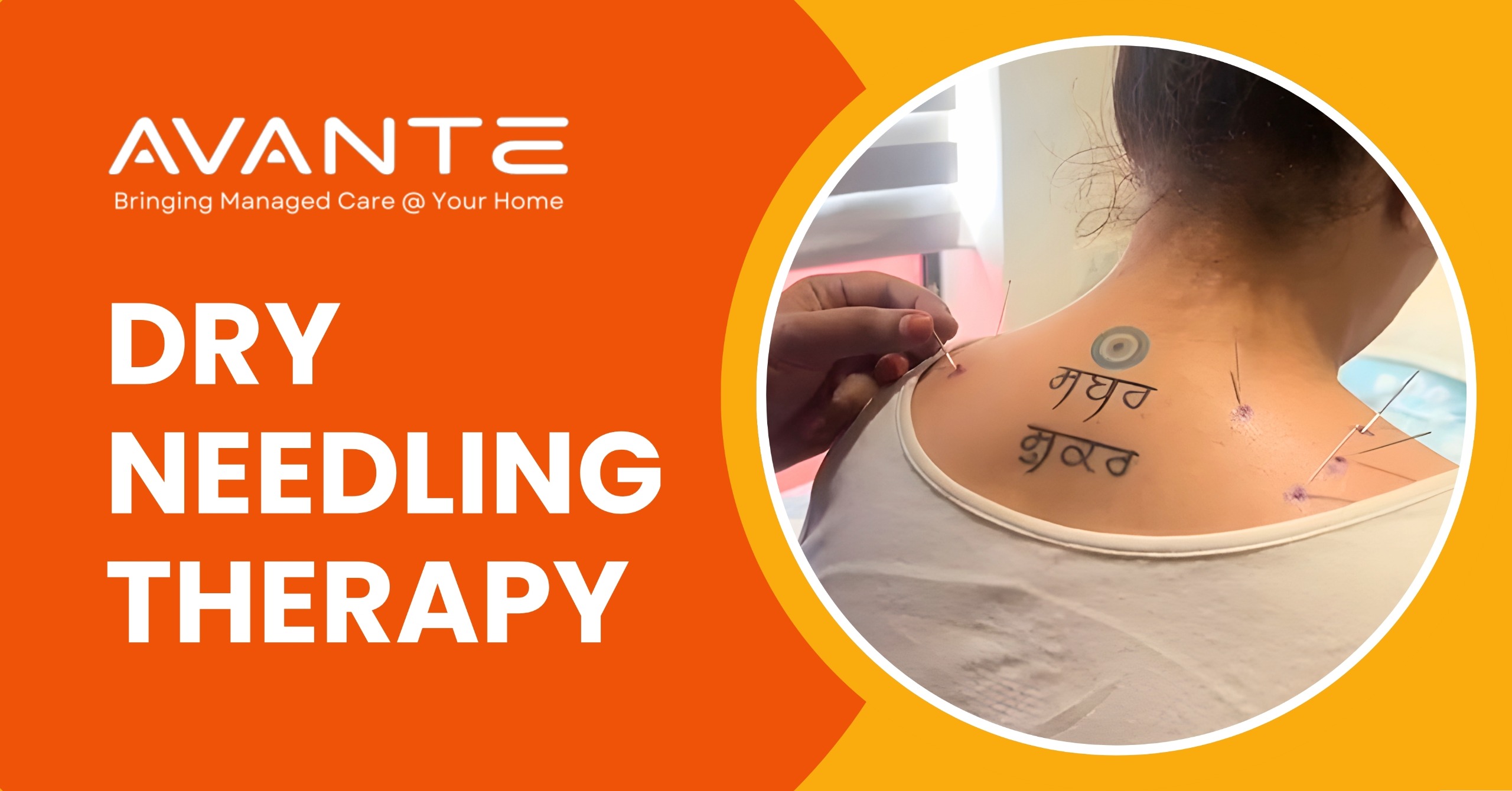 Dry Needling Therapy